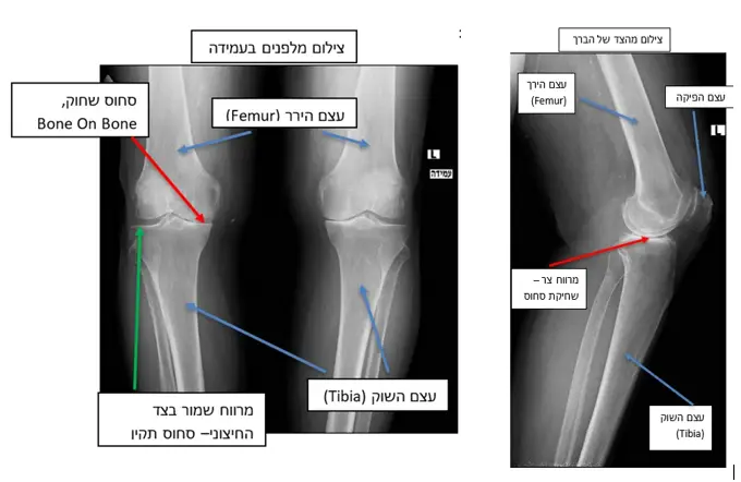 מאמר ניתוח החלפת ברך - תמונה ראשונה